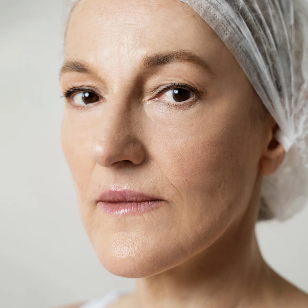 Comparaison avant et après injections de Botox montrant un résultat naturel en médecine esthétique