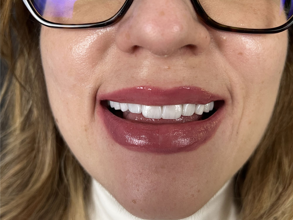 Dentition après traitement dentaire esthétique en Tunisie