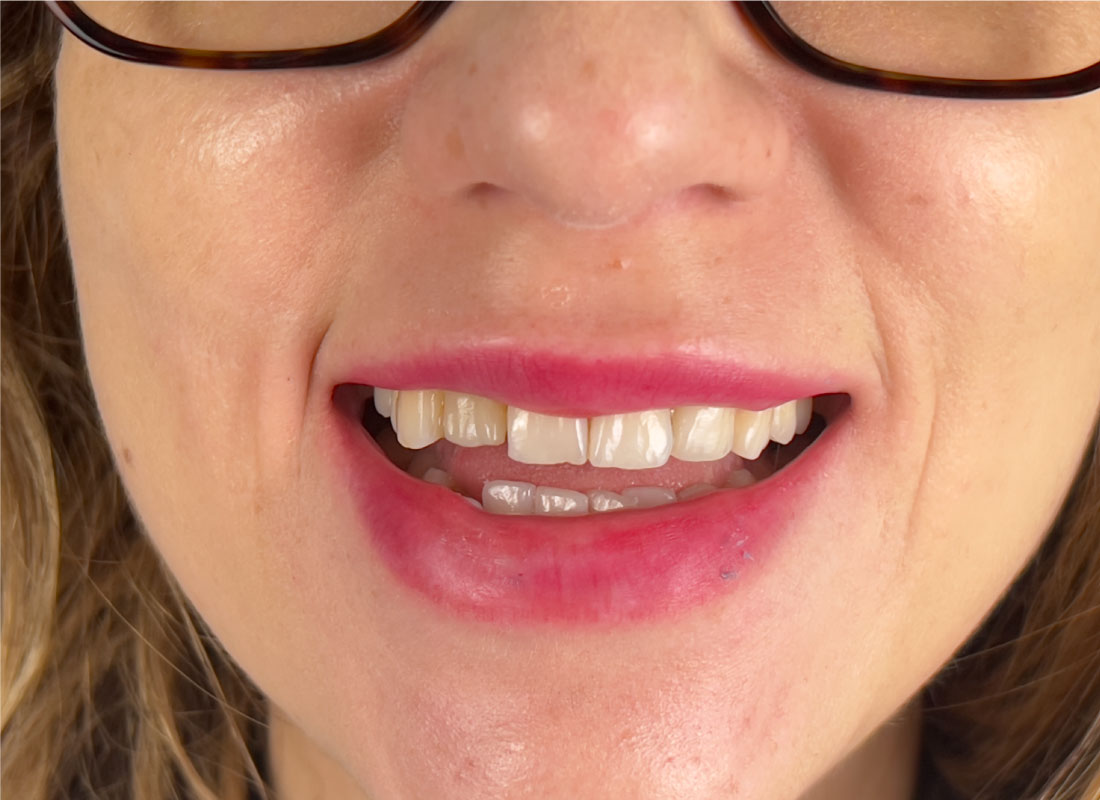 État initial de la dentition avant traitement dentaire en Tunisie