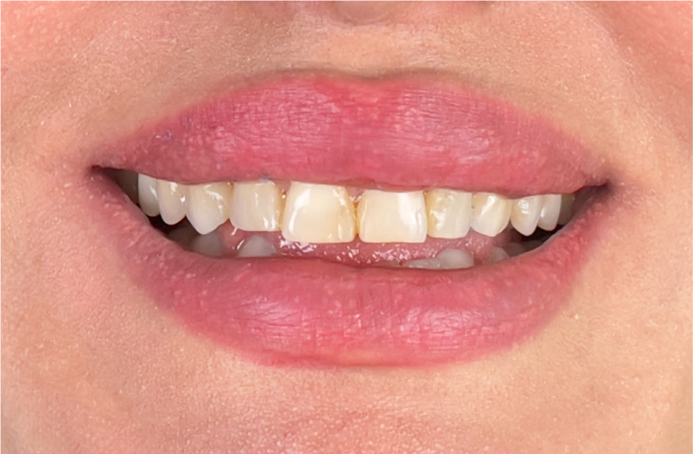 Dentition avant soins dentaires esthétiques en Tunisie