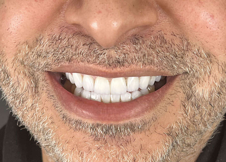 Sourire final après blanchiment et soins dentaires en Tunisie