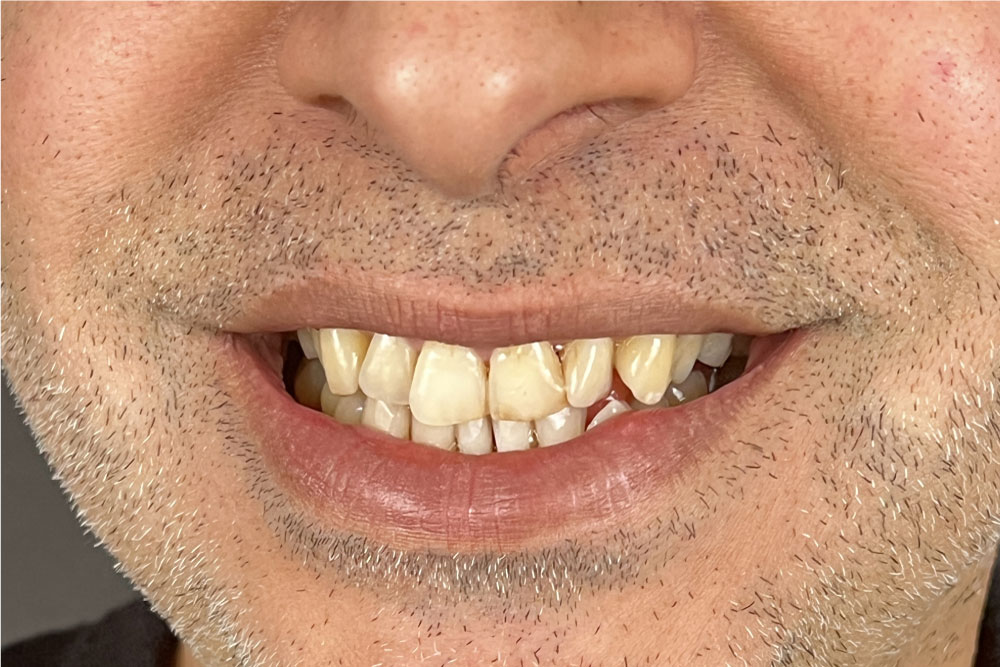 Sourire avant traitement dentaire en Tunisie – Luxor Health